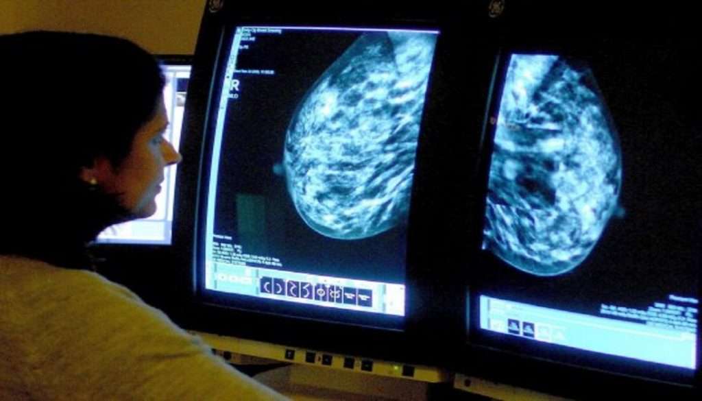 Zbulohet metodë e re për të parandaluar kancerin e gjirit