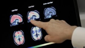 Alzheimer mund të zbulohet përmes një analize gjakut