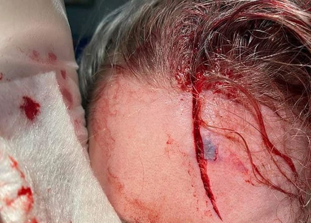 Pamje të rënda/ Infermierja sulmohet nga pacienti, pëson lëndime të thella në kokë