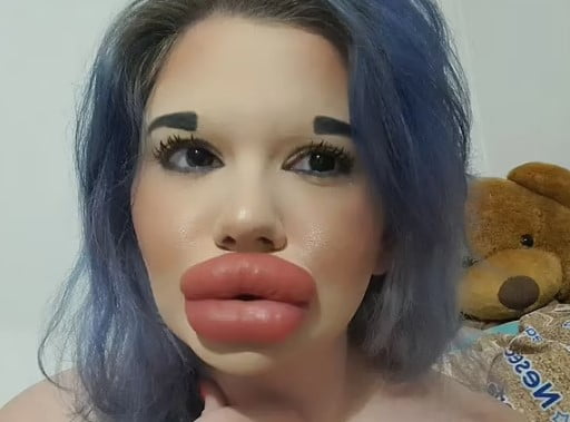 Ka buzët më të mëdha në botë, por 24-vjeçarja po pret injeksionin e radhës që të duket si kukull Bratz
