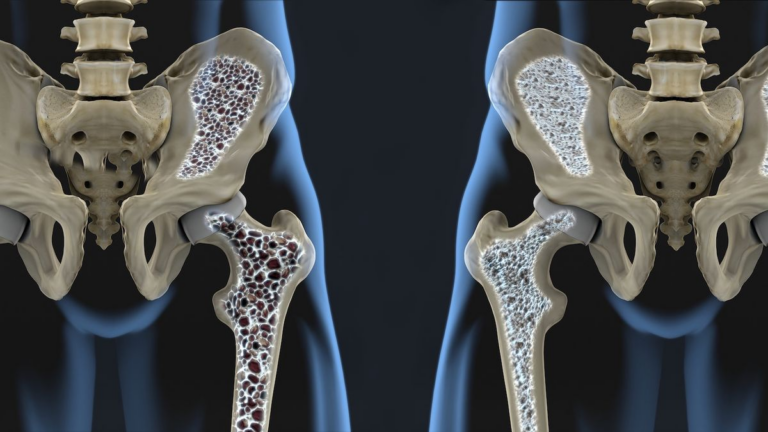 Krijohet medikamenti i parë kundër osteoporozës